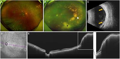Case report: Intraretinal hyperflow microinfiltration lesions on swept-source optical coherence tomography angiography as a potential biomarker of primary vitreoretinal lymphoma